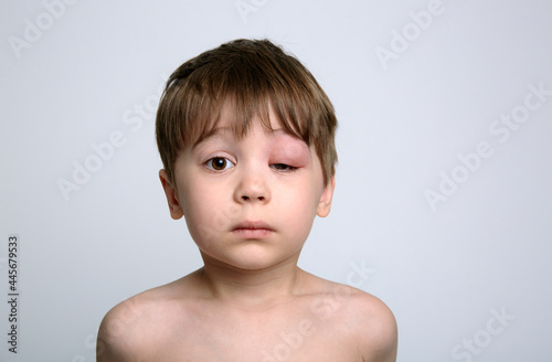 Obraz na płótnie A boy with swollen eye from insect bite