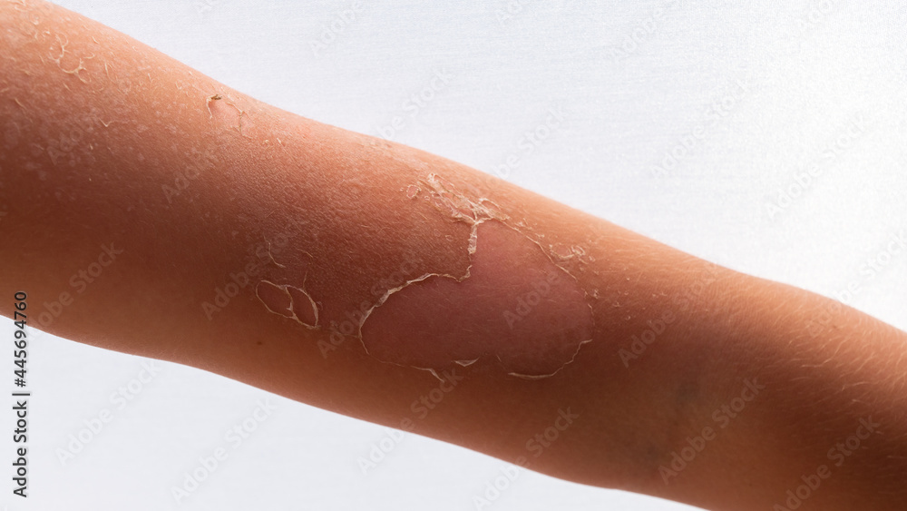 skin after sunburn. skin slips Stock Photo Adobe Stock