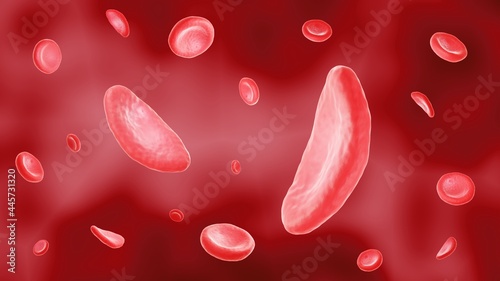 Sickle cell anemia disease, Deformed and normal red blood cells photo