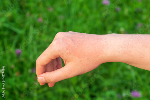 A red hot sun allergy spot on the arm is usually painful or itchy. © Виталий Борковский