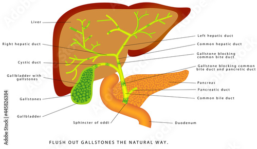 Gallstones in the gallbladder. Human liver and gallbladder anatomy. Flush out gallstones the natural way. Gallstones in the gallbladder and bile duct. Cholesterol stones and pigment stones. photo