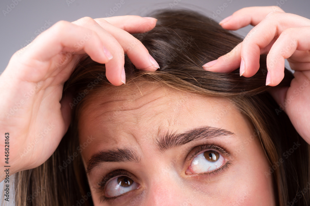 Obraz premium Woman with hair loss problem. Portrait of Young girl with a bald. Head shot of a nervous girl with a hairbrush.