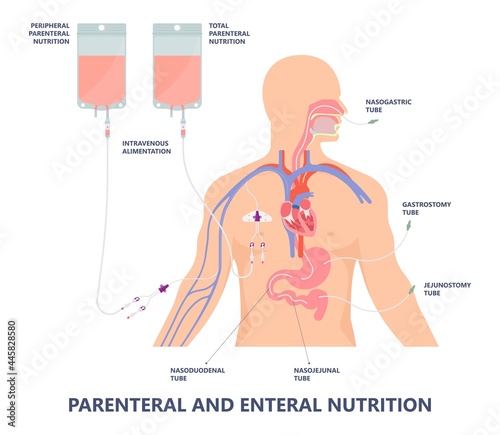 TPN PPN Total tube nutritional partial line PICC IV care unit ICU tract enteral gavage nose PEG stomach surgery system small nose large food cancer eat NG bowel PEJ pump