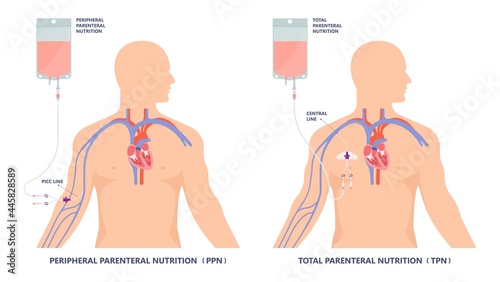 TPN PPN Total tube nutritional partial line PICC IV care unit ICU tract enteral gavage nose PEG stomach surgery system small nose large food cancer eat NG bowel PEJ pump