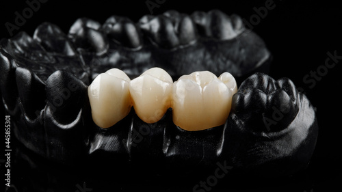 ceramic crowns in the chewing area on the black model