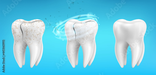 3d realistic clean and dirty tooth set on blue background, Teeth cleaning and whitening procedure. Dental health concept. Healthy enamel. Vector illustration.