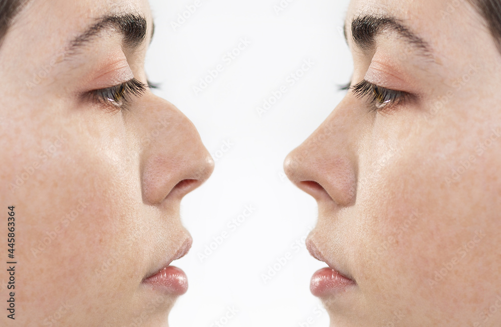 Obraz premium Two female faces close-up showing the result before and after rhinoplasty. Side view. White background. The concept of rhinoplasty