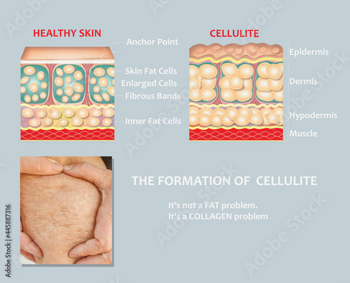 forming of underskin cellulite illustration