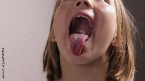 Girl of 9-10 years old at an appointment with a jaw surgeon or dentist. Child with his mouth wide open and his tongue hanging out. Close-up photo