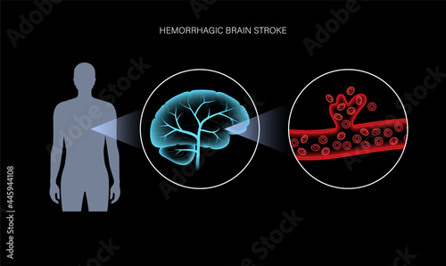 Brain stroke hemorrhagic