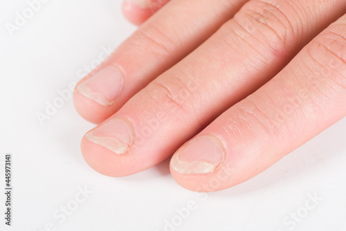 Onychomycosis or fungal nail infection on damaged nails after gel polish  onychosis. 