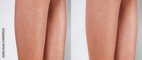 Image before and after Legs hairs removal concept.  photo