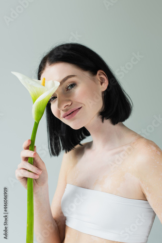 Smiling woman with vitiligo holding calla lily isolated on grey