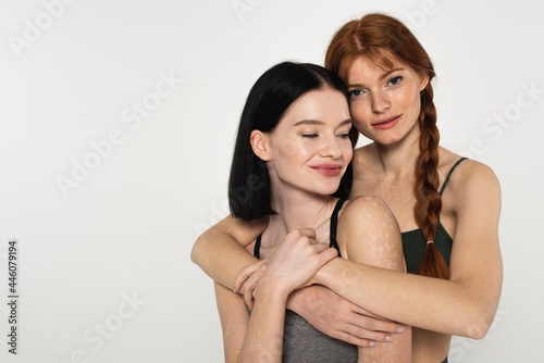 Sportswoman with freckles embracing friend with vitiligo isolated on grey