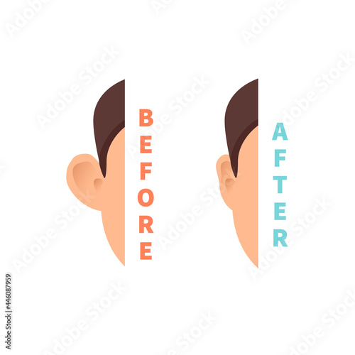 Cosmetic facial plastic ear surgery for men. Before and after otoplasty surgical correction procedure. Pinnaplasty ear pinning reshaping design template. Medical vector illustration.