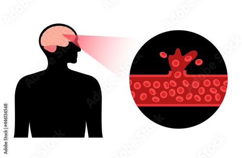 Brain stroke hemorrhagic