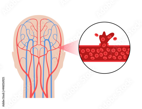 Brain stroke hemorrhagic