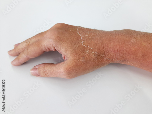 Woman's dry and damaged skin on hand after a sunburn on a white background.