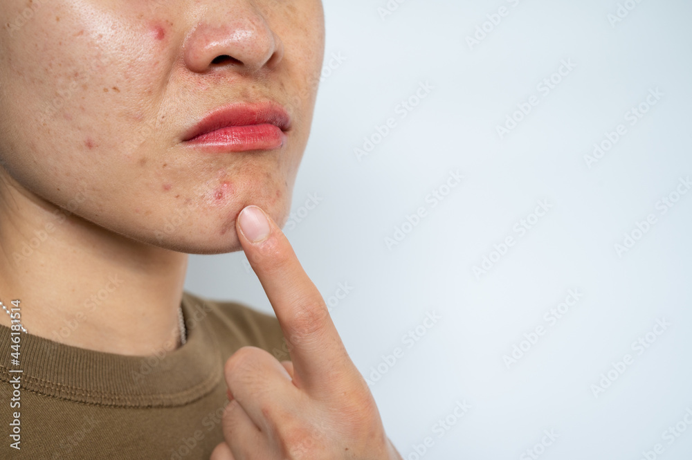 Close up of woman pointing to acne occur on her lower face. Inflamed acne consists of swelling