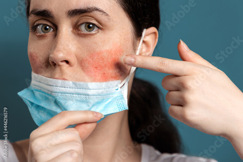 Rosacea. Close up portrait of a young woman shows redness on her cheeks from wearing a protective mask. Blue background. The concept of maskne and skin irritation photo