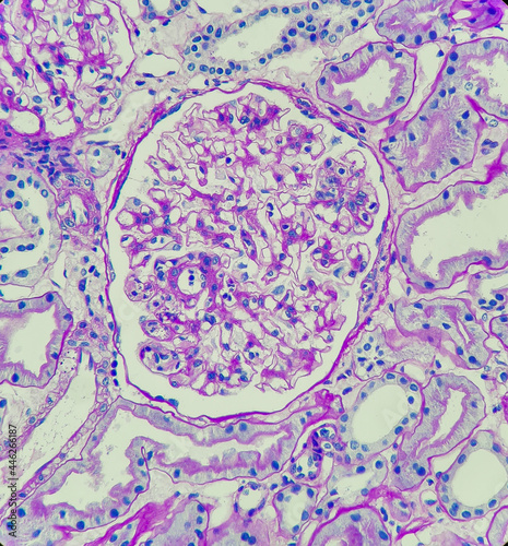 Photo of glomeruli with segmental endocapillary hypercellularity in patient with IgA nephropathy, magnification 400x, photo under microscope