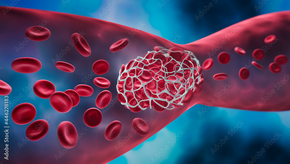 Blood clot blocking a blood vessel - obrazy, fototapety, plakaty 