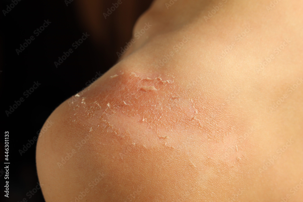 Peeling of the skin after sunburn on a person's shoulder, sunburn