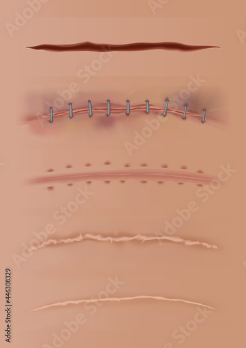 Set of healing wounds, skin scars, stitched gash and cuts. Realistic surgical sutures, stitched wounds at different healing stages isolated on human skin background