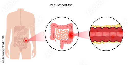 Chrons disease concept