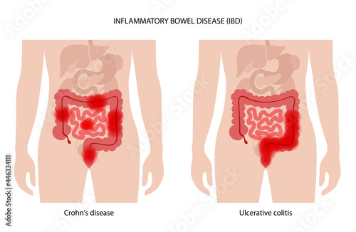 Inflammatory bowel disease