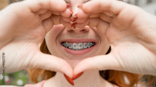Close-up portrait of a young red-haired woman with braces on her teeth holding her hands in the shape of a heart. Orthodontic appliances for a perfect smile.