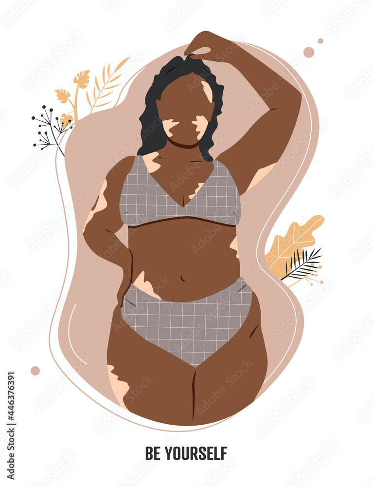 Be yourself card. Beautiful vitiligo woman, model. Flat vector illustration.
Be yourself card. Beautiful vitiligo woman, model. Flat vector illustration.