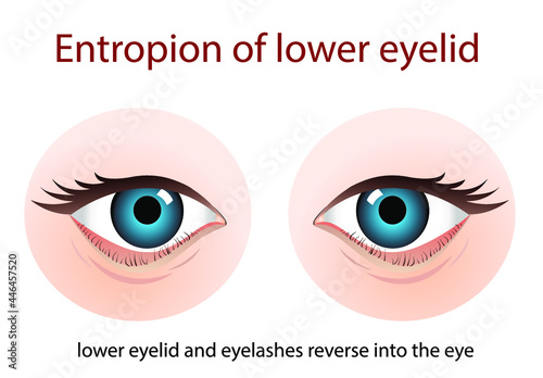 Entropion, a condition in which your eyelid is turned inward  against your eyeball,