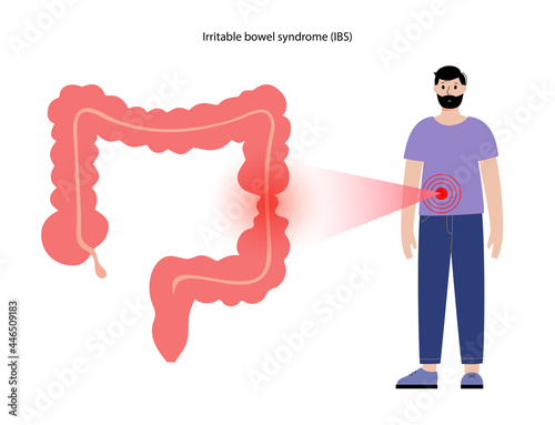 Irritable bowel syndrome