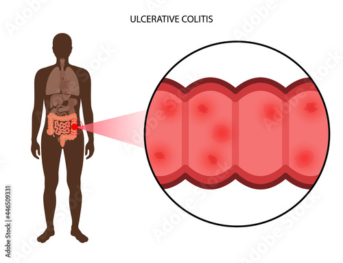 intestine ulcerative colitis