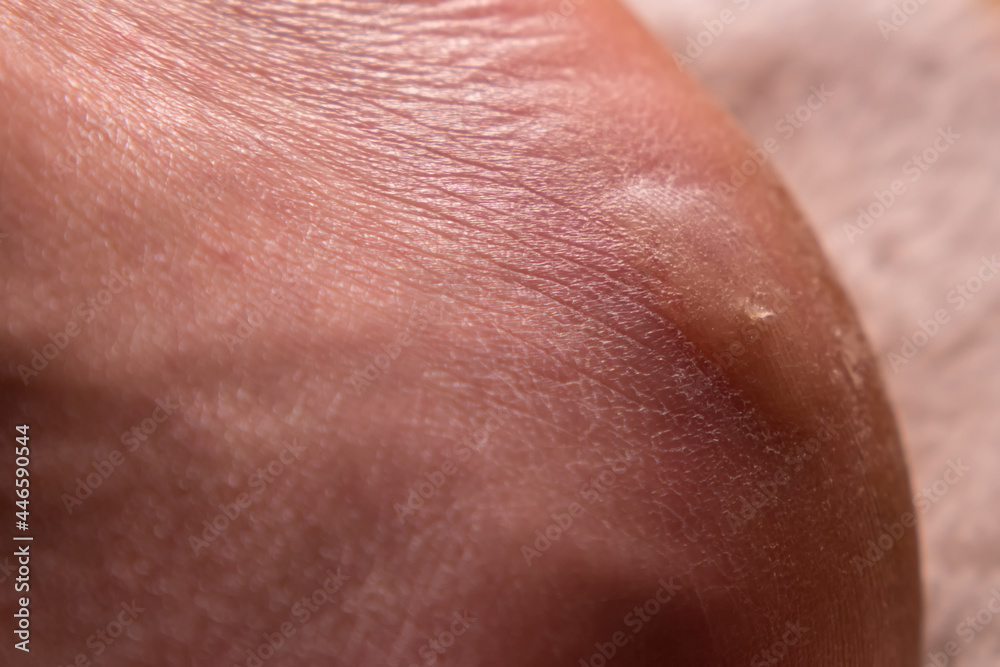 Fototapeta premium Close-up of a man's foot with a callus and dry skin.