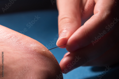 Close-up female fingers using a needle pierce a callus on the heel.