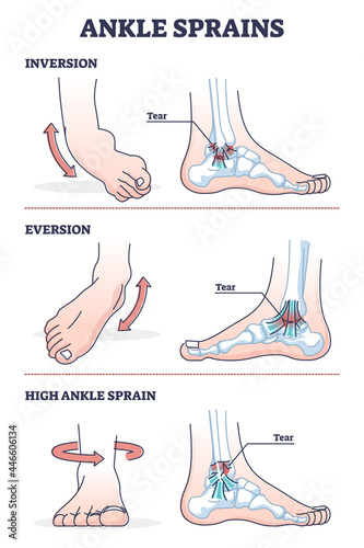 Ankle sprains situations with inversion and eversion injury outline diagram. Twisted foot or leg pain and swollen inflammation cause with bone and ligament xray medical explanation vector illustration photo