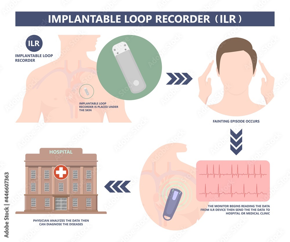 Vektorová grafika „loop holter event atrial heart attack stroke ECG EKG