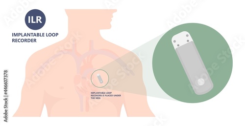 loop holter event atrial heart attack stroke ECG EKG device monitoring rhythm cardiac chest risk ILR Implantation ICD atrial rate beat pain artery pulse