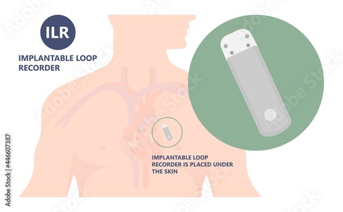 loop holter event atrial heart attack stroke ECG EKG device monitoring rhythm cardiac chest risk ILR Implantation ICD atrial rate beat pain artery pulse