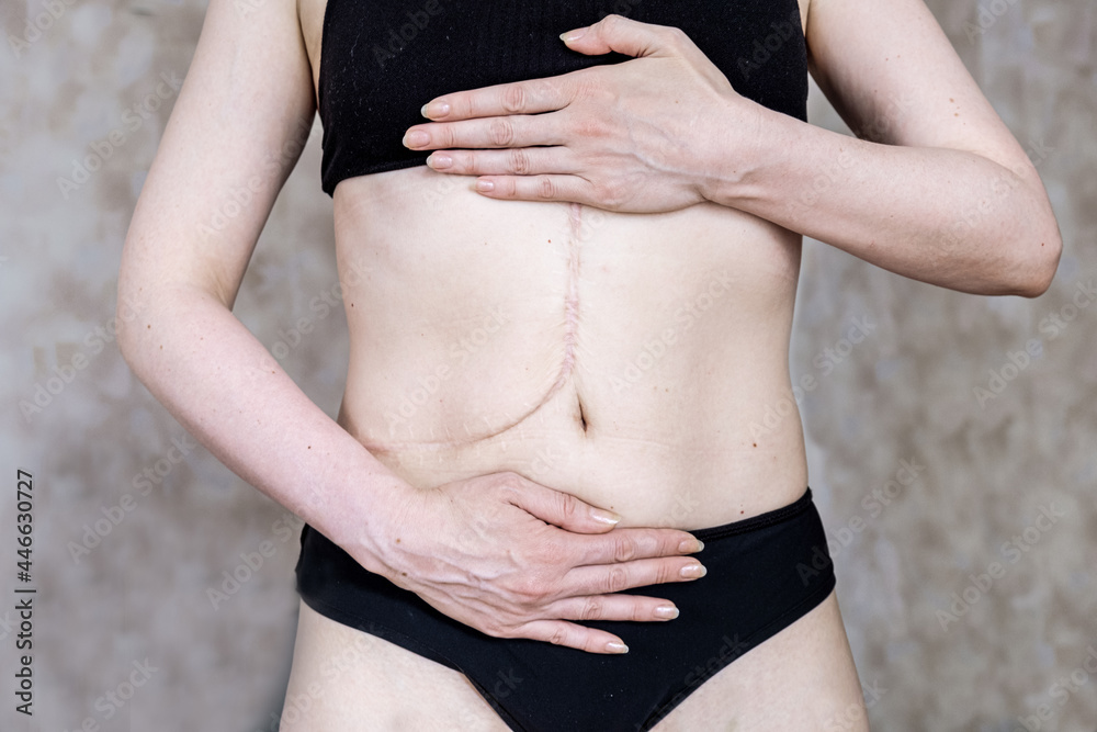 Photo of a woman's body with a scar after a liver transplant surgery. A