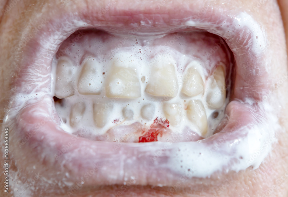 Obraz premium blood on the gums when brushing teeth with toothpaste. close-up