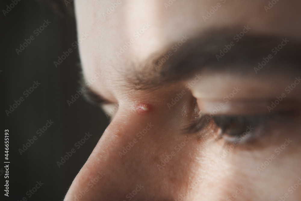 Macro photos of the white with red ripe pimple on the face of a man near the eye and nose