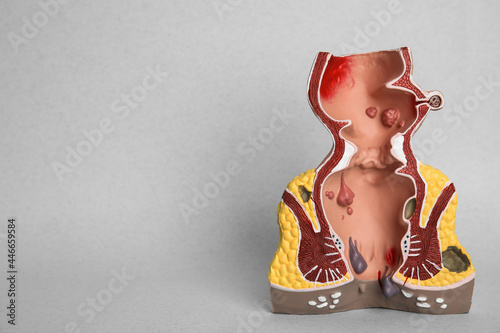 Anatomical model of rectum with hemorrhoids on light background. Space for text