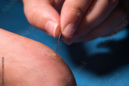 Women s fingers with a needle pierce a callus on the heel
