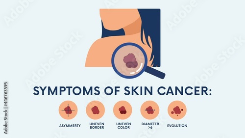 Skin cancer symptoms 2D animation on transparent background. Melanoma concept. Can be used for topics like oncology, tumor, awareness, healthcare