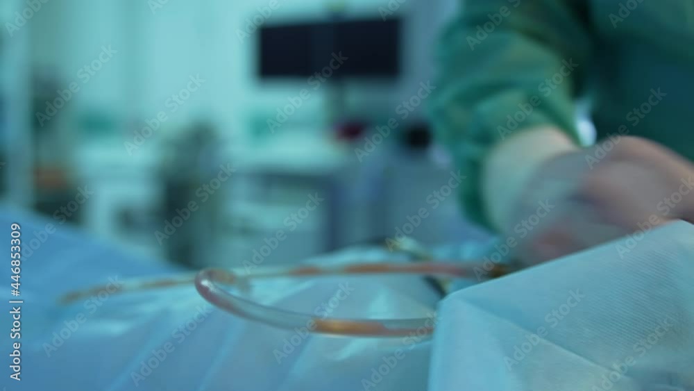 Surgeon's hands collects fat into pipe. Liposuction procedure for improvement patient's body. Close-up.