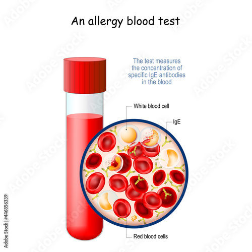 allergy blood test.
