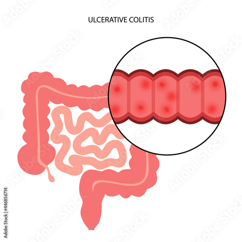 intestine ulcerative colitis